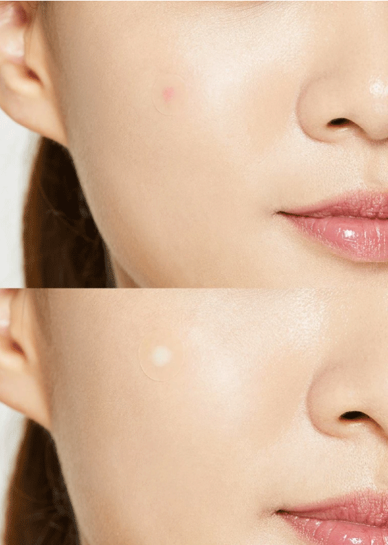 skincare-kbeauty-glowtime-COSRX Acne Pimple Master Patch