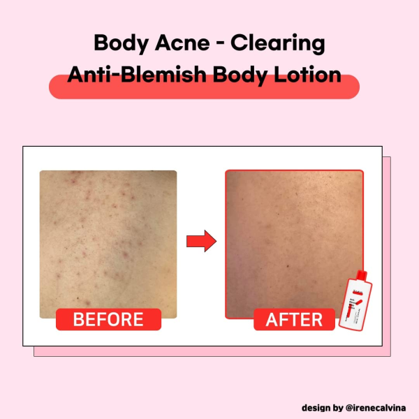 skincare-kbeauty-glowtime-tiam anti blemish body lotion