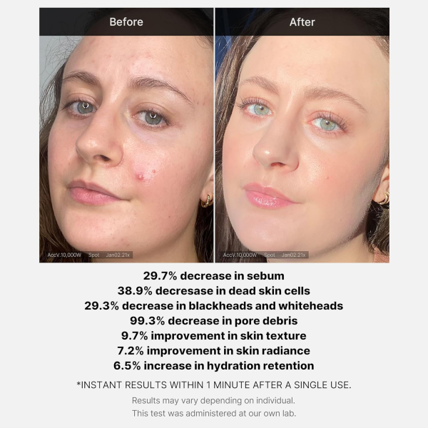 skincare-kbeauty-glowtime-medicube red acne succinic acid peel