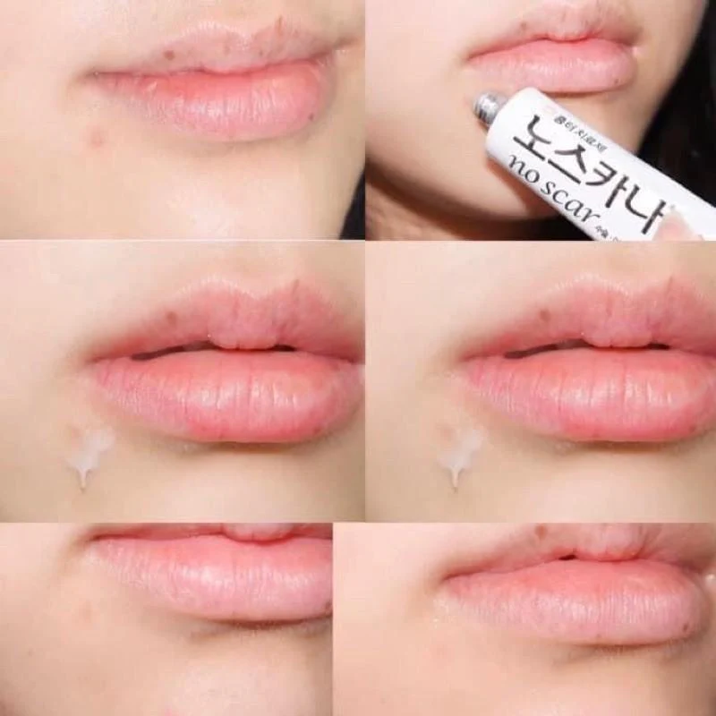 NOSCARNA Gel 1 skincare-kbeauty-glowtime-noscarna gel